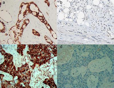 MET and FASN as Prognostic Biomarkers of Triple Negative Breast Cancer: A Systematic Evidence Landscape of Clinical Study